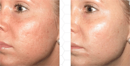 Aging Skin and Face Before and After