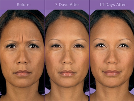 Before and After Botox Treatment - Wilmington, DE
