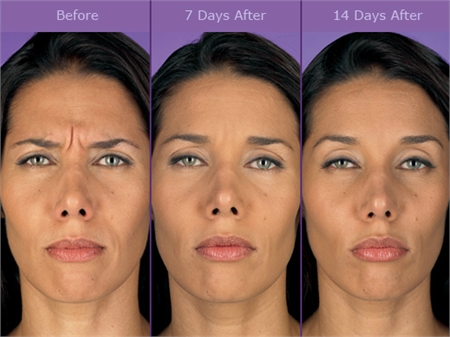 botox does long after before injection last facial works narins wrinkles allergan courtesy woman wilmington surgery westchester choose board injections